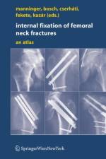 Internal fixation of femoral neck fractures