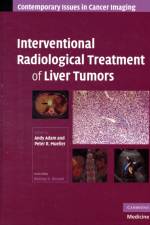 Interventional Radiological Treatment of Liver Tumors