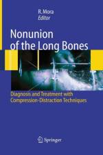 Nonunion of the Long Bones