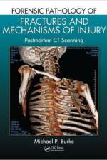 Forensic Pathology of Fractures and Mechanisms of Injury af Michael P. Burke