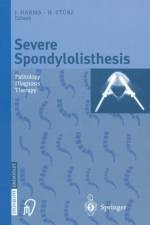 Severe Spondylolisthesis