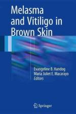 Melasma and Vitiligo in Brown Skin