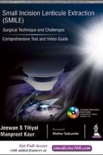 Small Incision Lenticule Extraction (SMILE): Surgical Technique and Challenges af Jeewan S Titiyal