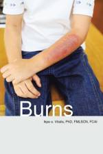 Burns af Fcai