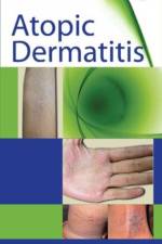 Atopic Dermatitis af Satish Udare