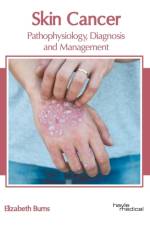 Skin Cancer: Pathophysiology, Diagnosis and Management