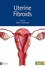 Uterine Fibroids