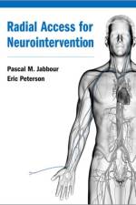 Radial Access for Neurointervention