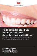 Pose immédiate d'un implant dentaire dans la zone esthétique af Imen Kalghoum