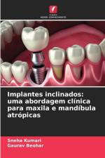 Implantes inclinados: uma abordagem clínica para maxila e mandíbula atrópicas af Sneha Kumari
