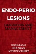 Endo-Perio Lesions af Swatika Kumari