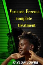 Varicose eczema Complete treatment af Taylor Jones