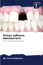 Otkaz zubnogo implantata af Akshi Varshney