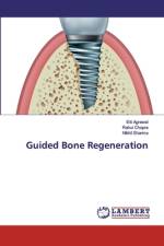 Guided Bone Regeneration af Eiti Agrawal