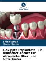 Gekippte Implantate: Ein klinischer Ansatz für atropische Ober- und Unterkiefer af Sneha Kumari