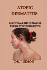 Atopic Dermatitis af J Simon