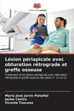 Lésion périapicale avec obturation rétrograde et greffe osseuse af María José Jarrín Peñafiel