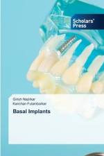 Basal Implants af Girish Nazirkar